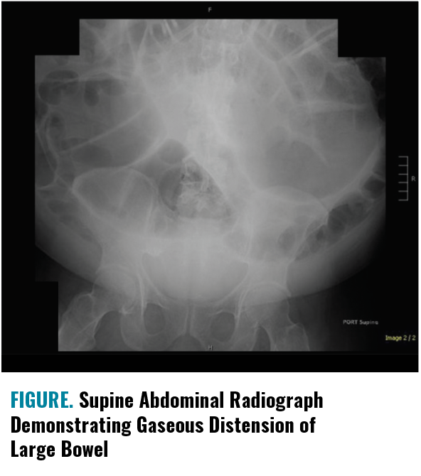 FIGURE. Supine Abdominal Radiograph Demonstrating Gaseous Distension of Large Bowel