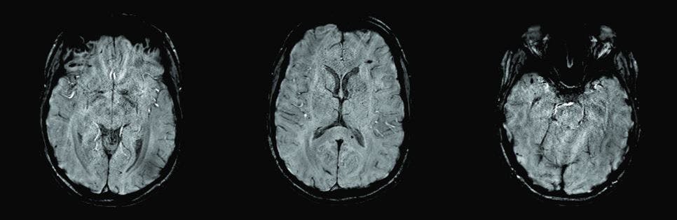 Brain MRI of a 23-year-old woman presenting with newonset paranoia
