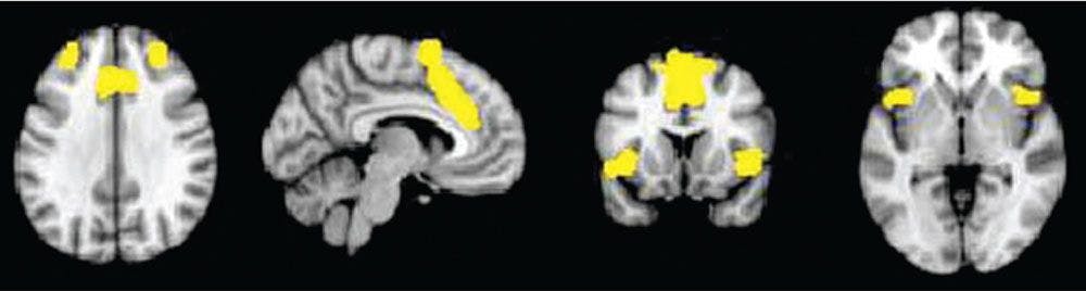 Bilateral dorsal anterior cingulate gyrus and insula are identified nodes