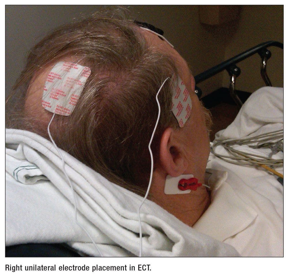 Right unilateral electrode placement in ECT.