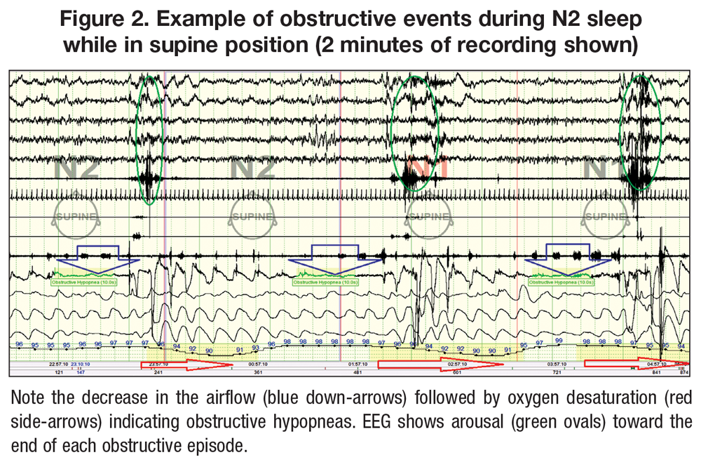 Example of obstructive events during N2 sleep while in supine position