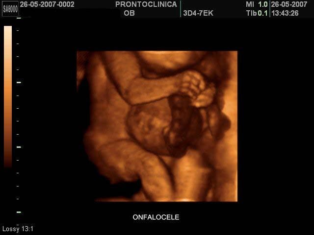 3D Image of a Fetal Omphalocele