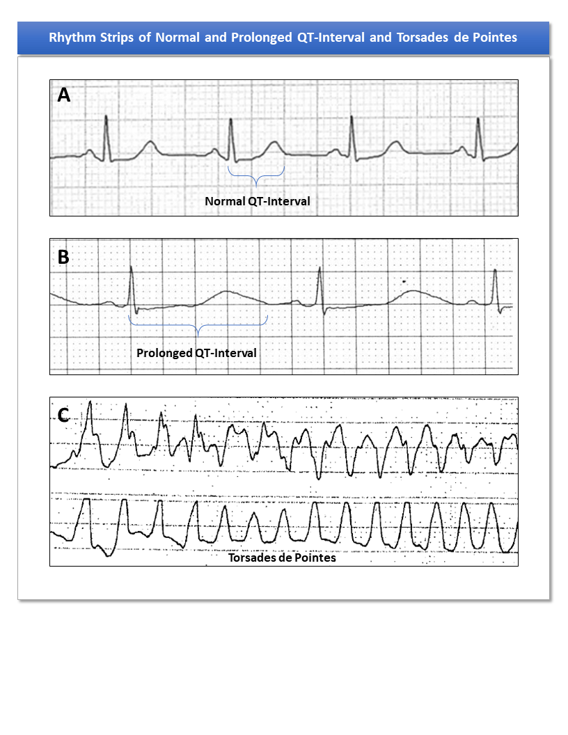 Figure 1. Rhythm Strips of Normal and Prolonged QT-interval and Torsades de Pointes.  