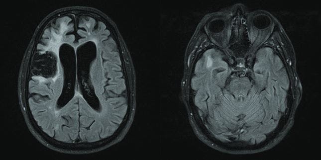 Brain MRI of a 60-year-old man presenting with misidentification delusions
