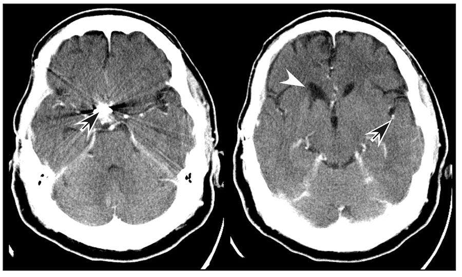 CT images of a man in his mid-50s with worsening cognitive and mood symptoms