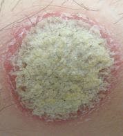 Treating Psychiatric Patients With Psoriasis: Clinical Considerations
