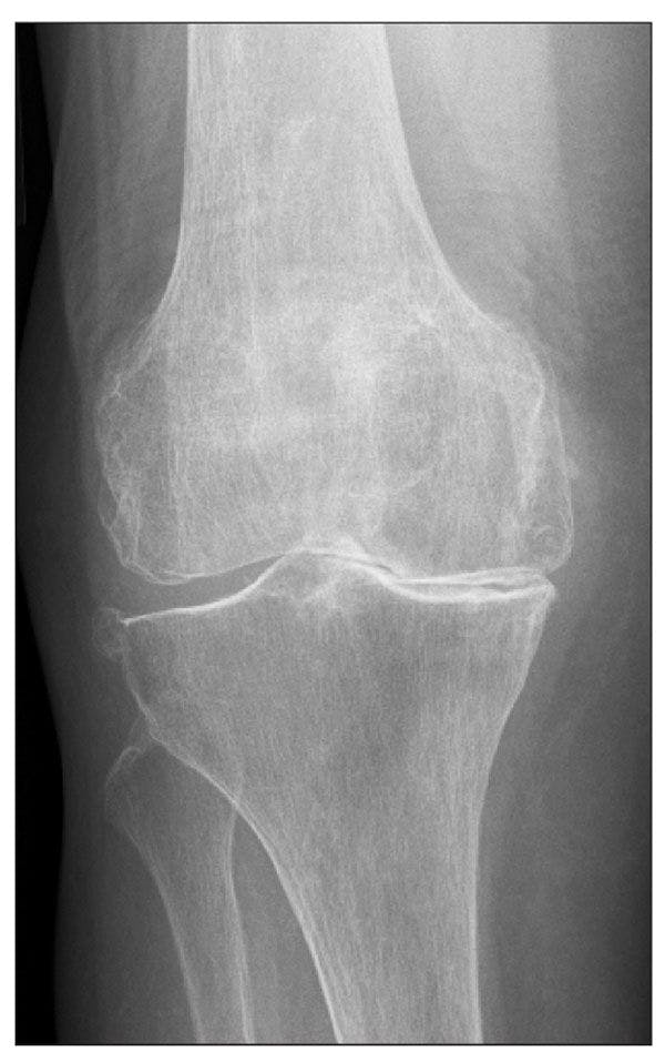 Knee pain in an 81-year-old man