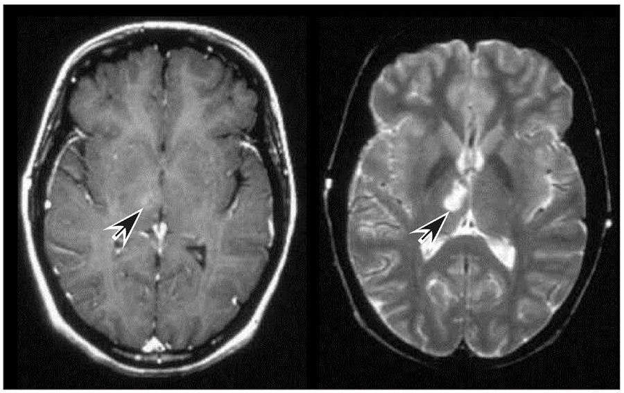MRI of a woman in her mid-40s with cognitive deficits, mood disorder
