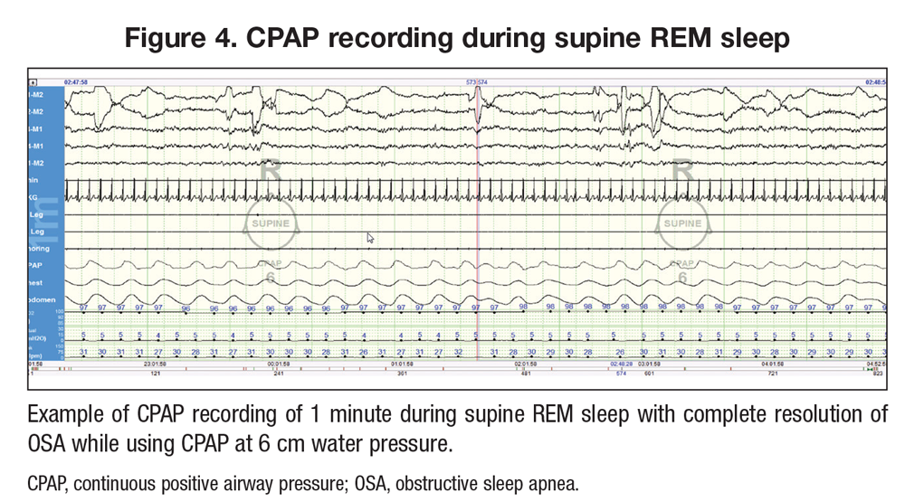 CPAP recording during supine REM sleep