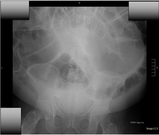 Figure. Supine Abdominal Radiograph Demonstrating Gaseous Distension of Large Bowel 