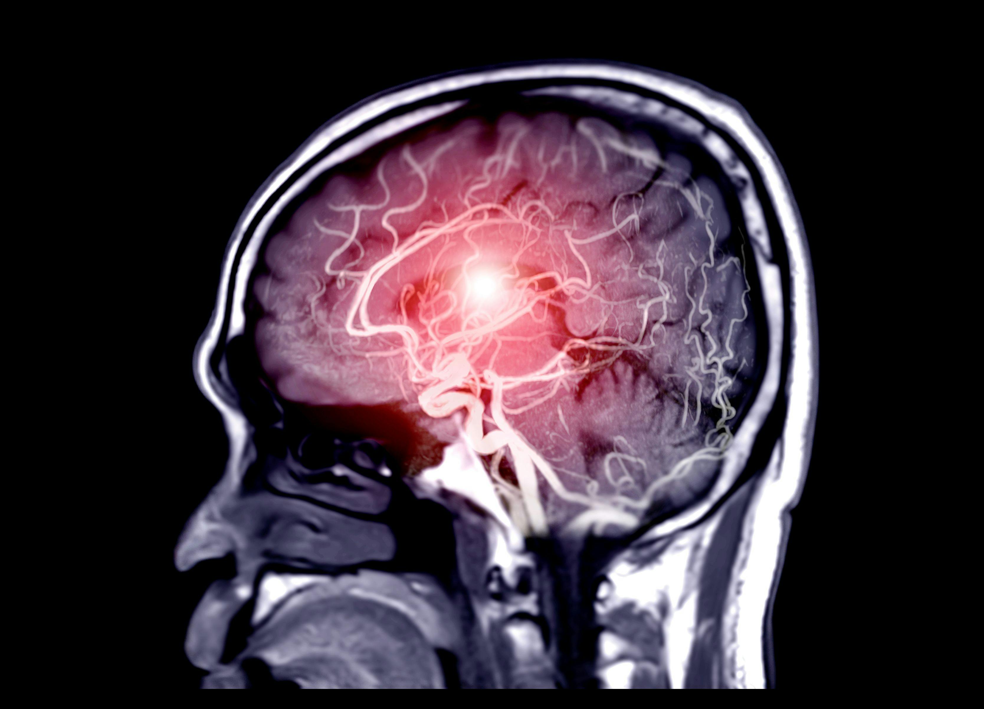 psychiatric implications of stroke