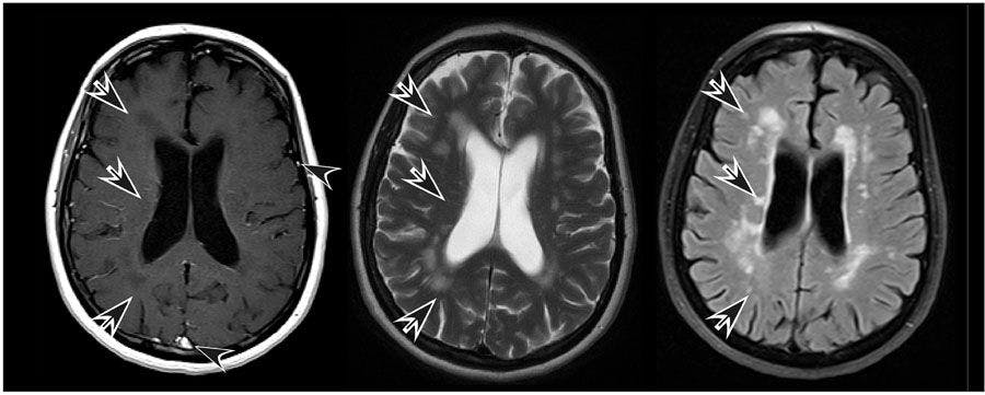 MRI of a middle-aged woman with history of several decades of multiple sclerosis
